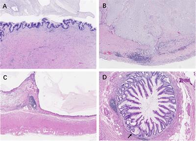 Significance of the Entire Appendiceal Evaluation in the Diagnosis of Serrated Lesions, Low-Grade Appendiceal Mucinous Neoplasm, and Appendiceal Diverticulosis Disease